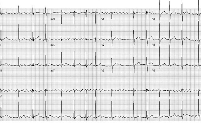 atrial fibrillation coarse