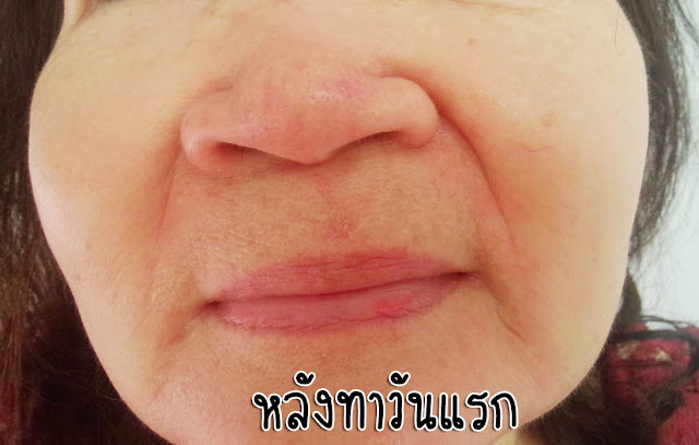 หลังทา Defenza cream วันแรก