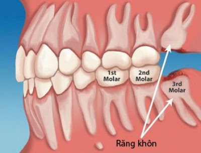 Vì sao răng khôn mọc muộn?