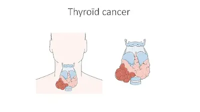 A graphics demonstrating Thyroid Cancer