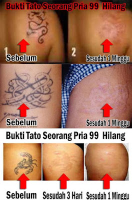 tattonox obat penghapus tatto permanen