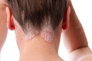 https://skincareayurveda.com/psoriasis-treatments/