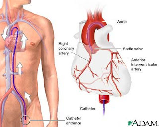 Angiography