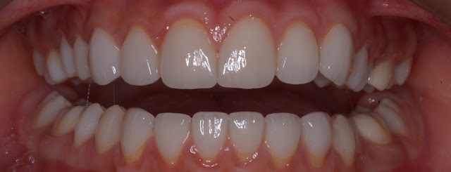 After Treatment of Smile Design with Ceramic Veneers