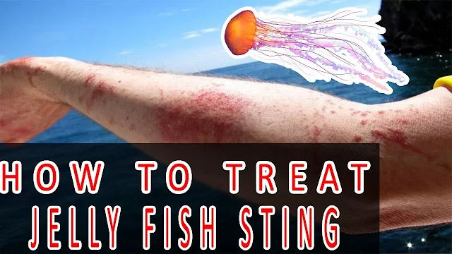 Top 10 Ways To Treat Jellyfish Stings At Home