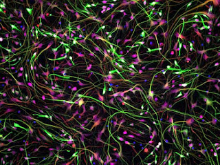 La depresión, el estrés postraumático o la ansiedad tienen su consecuente imagen cerebral. En esta instantánea, células madre neurales de un humano. La tinción muestra el ADN (azul) y los marcadores neuronales (verde), de los astrocitos (rojo) y del factor neurotrópico derivado del cerebro (púrpura). (Foto: Kymmy Lorrain | BrainCells Inc.)