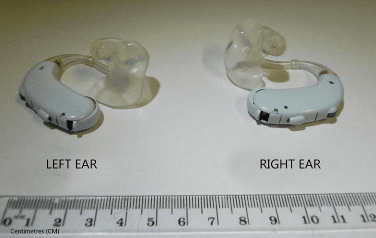 Cara Rawatan Tinnitus (Telinga Berdesing) Secara Semulajadi