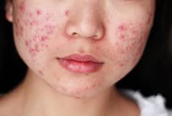 Acne scars vary in size, color and level of pain.  The following types are possible:  Whiteheads: These live under the skin and are small Blackheads: Clearly visible, they are black and appear on the surface of the skin Popules: Small, usually pink bumps that appear on the surface of the skin Blisters: Clear on the skin surface. They are red at their base and pus at the top Nodules: clearly visible on the skin surface. They are large, firm, painful pimples that are deeply embedded in the skin. Cyst: Clearly visible on skin surface. They are painful and fill with pus. Ulcer scars form.