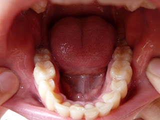 A photo of straight teeth after orthodontic treatment with fixed braces