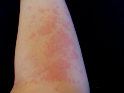 heat rash on legs. heat rashes on legs. mild heat