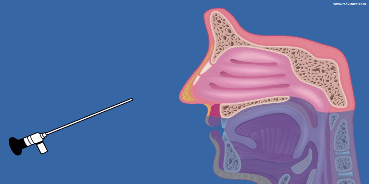 nasal-endoscope