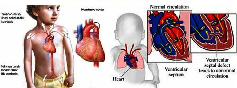 Kenali penyakit jantung berlubang pada bayi  Tasly 