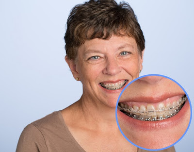 Có nên niềng răng khi lớn tuổi?