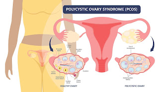 PCOS: Understanding Polycystic Ovary Syndrome and its Impact on Women's Health