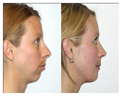 Chin Augmentation Surgery