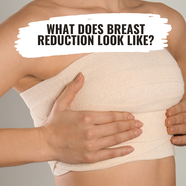 What does a breast reduction consultation look like morena filipina health blog