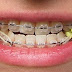 Chữa trị răng móm bằng cách nào hiệu quả?
