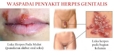 Obat Herpes Manjur dari Denature