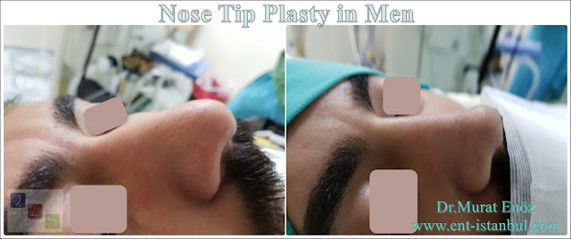 Droopy Nasal Tip - Open Technique Nose Tip Plasty in Men