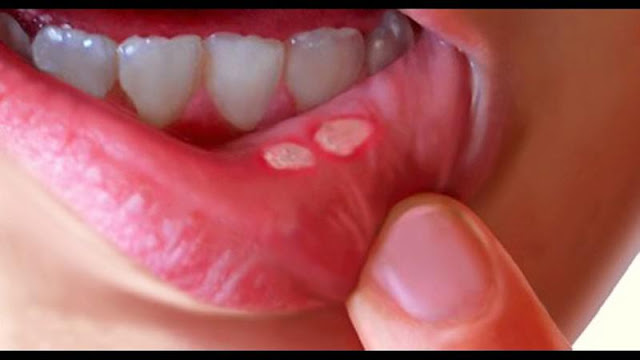 Canker sore on the tongue
