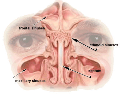 sinus infection