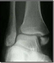 medialmalleolusfracture