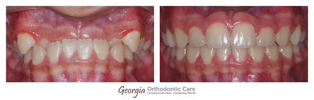 Underbite treatment, no jaw surgery, non extraction, class III, missing teeth, extracted teeth, Orthodontics, orthodontists, Clear, Invisible, Braces, Invisalign, underbite,class III, face mask, non-surgery, non-extraction, crossbite, overbite, class II, crooked, spaced, crowding, teeth, severe, jaw alignment, cosmetics, implants, children, dentists, dentistry, friendly, adults, children, family, Lawrenceville, Norcross, Buford, Hamilton Mill, Dacula, Auburn, Sugar Hill, Sugar Loaf, Doraville, Chamblee, Stone Mountain, Decatur, Collins Hill, Snellville, Suwanee, Grayson, Lilburn, Duluth, Cumming, Alpharetta, Marietta, Dekalb, Gwinnett, County, Atlanta, North Georgia, GA, Georgia, 30043, 30093, affordable, Vietnamese, Spanish, weekend, Saturday, appointments, Dr. Quang Nguyen, Georgia Orthodontic Care, Nguyen Orthodontics.