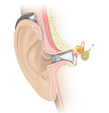 Earlens Corporation-Nonsurgical Hearing Solution Vibrating Eardrum Directly