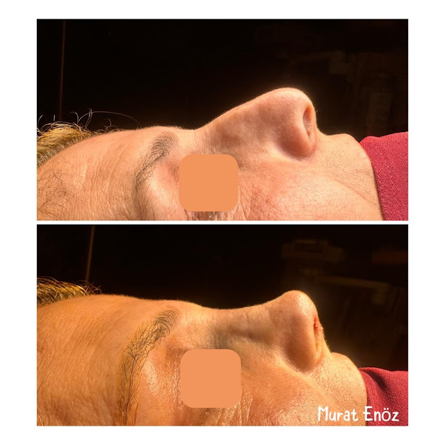 Why Does the Nose Tip Drop After Rhinoplasty?, Pig-like Nose After Nose Job, Excessively Raised Nose Tip After Cosmetic Nose Surgery