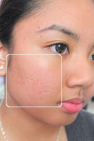 acne scarring treatment
