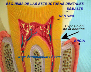 <Img src="esquema-exposición-dentina.jpg" width = "2464" height "1944" border = "0" alt = "Dibujo que muestra el cuello dental con dentina expuesta">
