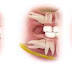 Răng khôn gây ra nhiều vấn đề răng miệng