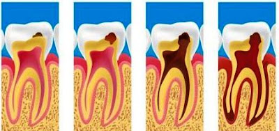 Cara Menyembuhkan Sakit Gigi Secara Alami Dengan Cepat