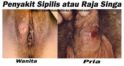 obat penyakit sifilis raja singa ok