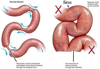 Cara Mengatasi Ileus Paralitik Yang Mengobatinya Dengan Cepat Dan Aman Tanpa Efeksamping