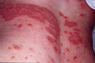 Apa itu Psoriasis dan Supplemen utk merawatnya 