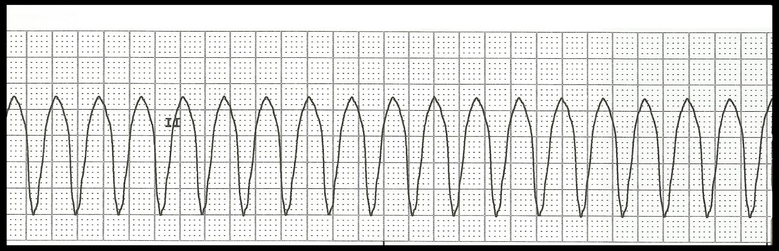 Float Nurse: Basic ECG Rhythm Test 05