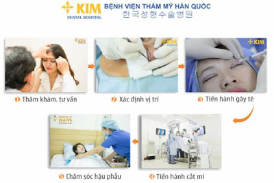 Bất ngờ với kết quả cắt mí mắt chảy xệ sau 3 tháng phẫu thuật