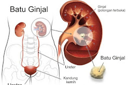 Jenis Penyakit Pada Ginjal Manusia