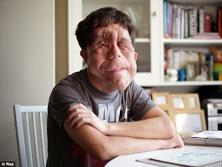 http://www.dailymail.co.uk/health/article-2592254/Adam-Pearson-hopes-beat-prejudice-Under-The-Skin.html