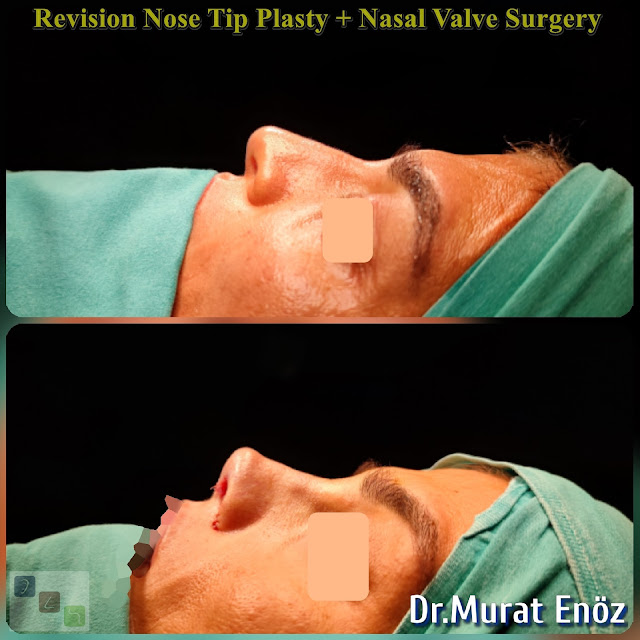 Open Technique Revision Nose Tip Plasty + Nasal Valve Surgery