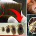 How To Remove Nits Of Lice Within 10 Minutes By Using The Method