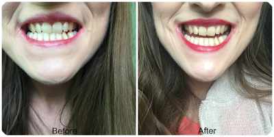 before and after beverly hills formula perfect white gold toothpaste 