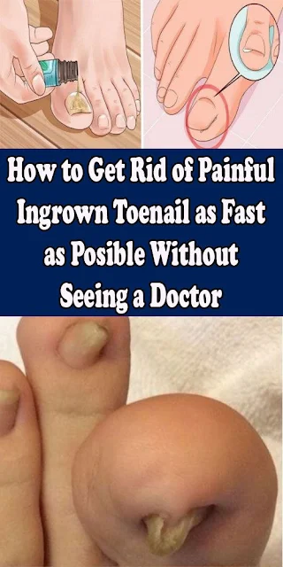 How To Get Rid Of A Painful Ingrown Nail Without a Doctor