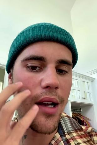 Justin perdeu o movimento em seu rosto ( Imagem: Instagram do Justin Bieber