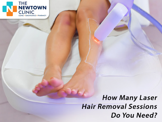 laser hair removal