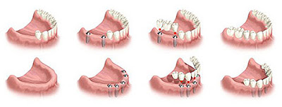 dental implants in Delhi