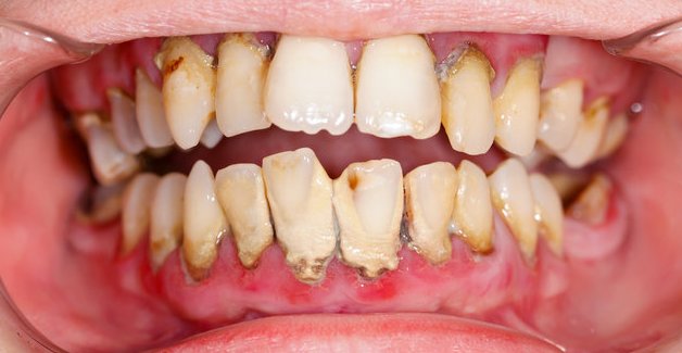 Bahaya Karang Gigi Yang Wajib Anda Ketahui
