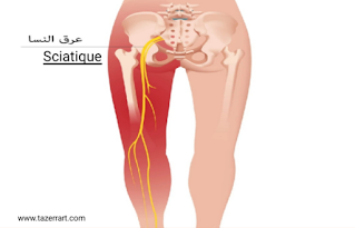 Sciatique