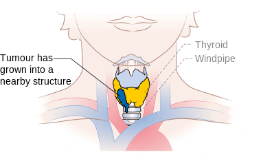 thyroid-cancer-treatment-iodine